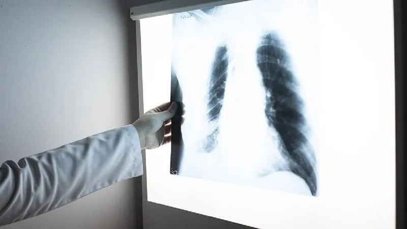 AstraZeneca, yapay zeka ile 5 milyon akciğer grafisinde kanser riski taraması yaptı