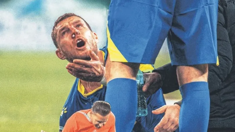 Edin Dzeko'nun Burnu Kırıldı: Ameliyat Gerekmiyor